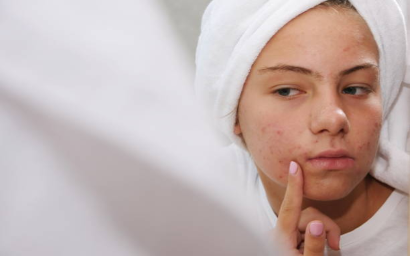 acne-treatment