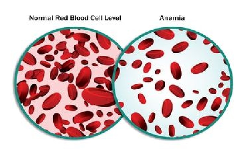 anemia
