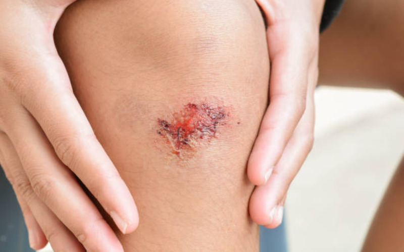helps-in-wound-healing