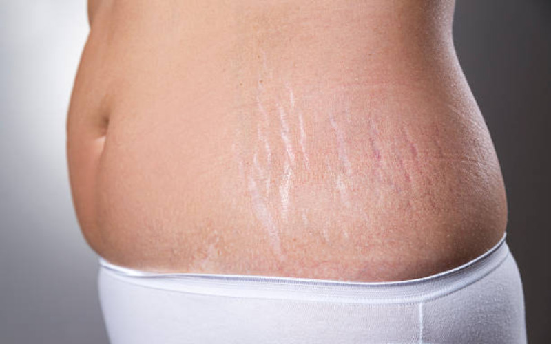 removing-stretch-marks